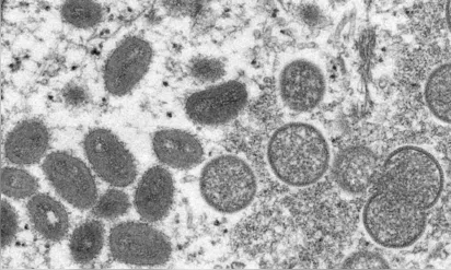 
		Saúde confirma sétimo caso de varíola dos macacos no país