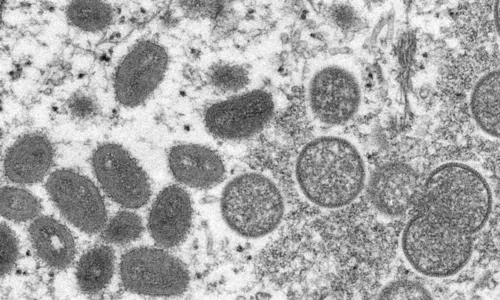 
				
					Ministério da Saúde confirma nono caso de varíola dos macacos no país
				
				