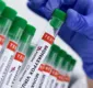 
                  Casos de varíola dos macacos chegam a 76 em todo o país