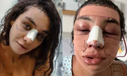
		Linn da Quebrada passa por cirurgia de afirmação de gênero e modifica o rosto; confira