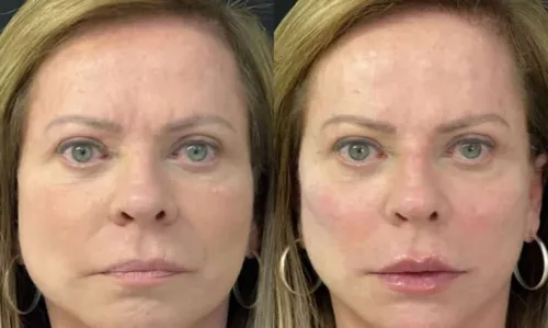 
				
					Christina Rocha, do Casos de Família, passa por harmonização facial e surpreende com resultado; veja antes e depois
				
				