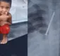 
                  Garoto de 3 anos morre com prego no pulmão no sul da Bahia