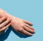 
                  Varíola dos macacos: dermatologistas alertam para risco de confundir lesões na pele com outras doenças
