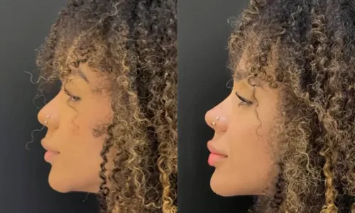 
				
					Brunna Gonçalves passa por novo procedimento no rosto; confira antes e depois
				
				