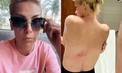 
				
					Ana Hickmann sofre acidente ao descer do cavalo: 'Não imaginei que o joelho fosse falhar'
				
				