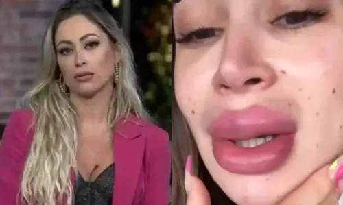 
				
					Ex-panicat Carol Narizinho fica irreconhecível após remover preenchimento labial; confira
				
				