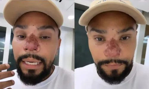 
				
					Naldo Benny sofre complicações ao fazer procedimento estético no nariz: 'Preocupado'
				
				