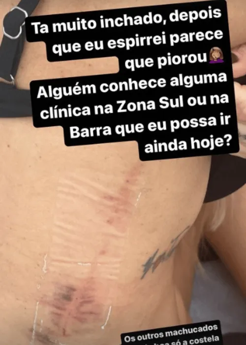 
				
					Liziane Gutierrez fratura costela em briga por ciúmes do ex: 'Briguei por causa de homem'
				
				