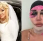 
                  Mulher Abacaxi choca ao aparecer completamente desfigurada após cirurgia
