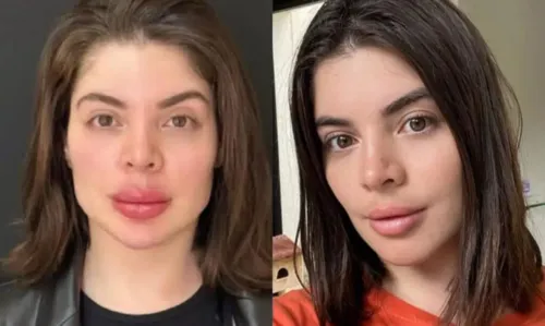 
				
					Gkay surge irreconhecível ao remover preenchimento labial: 'Tirei minha boca'
				
				