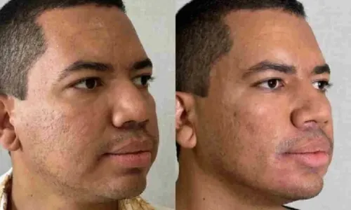 
				
					Ex-BBB Bruno Gaga passa por transformação com harmonização facial de R$ 25 mil; compare antes e depois
				
				